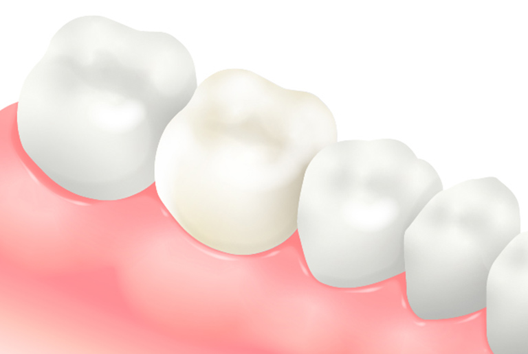 オールセラミッククラウン