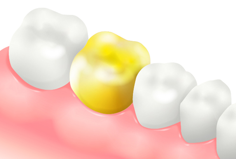 ゴールドクラウン