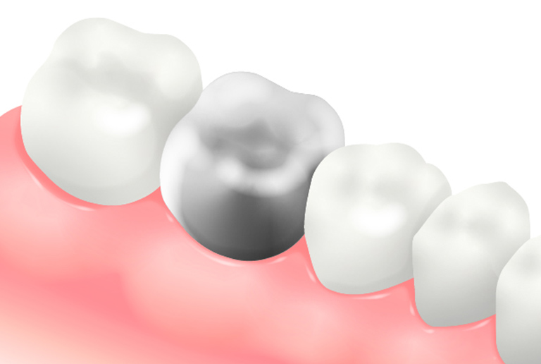 メタルクラウン（金属冠：銀歯）
