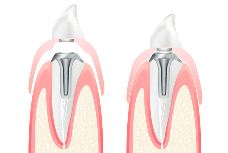 マグネットデンチャー（部分入れ歯）