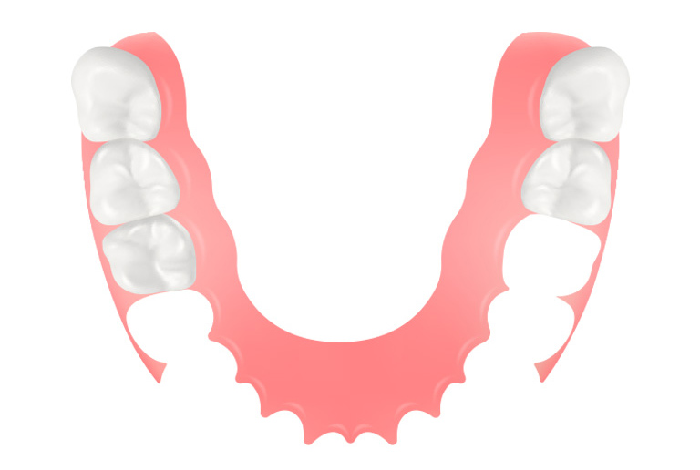 ノンクラスプデンチャー（部分入れ歯）