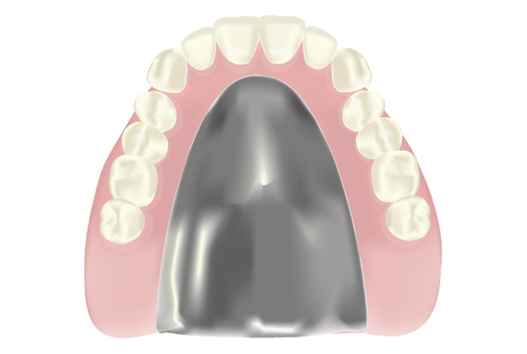 チタン床義歯（総入れ歯）
