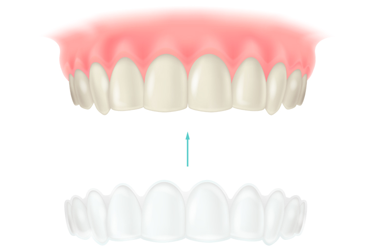 ホームホワイトニング