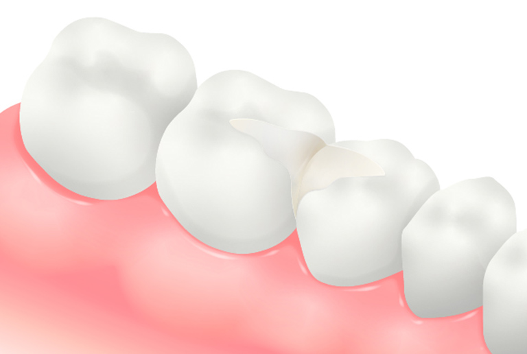 オールセラミックインレー