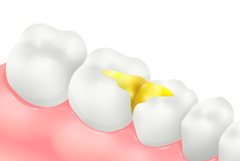 ゴールドインレー