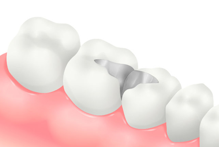 メタルインレー（銀色の金属素材）