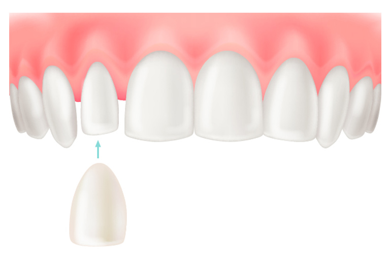 ラミネートべニア