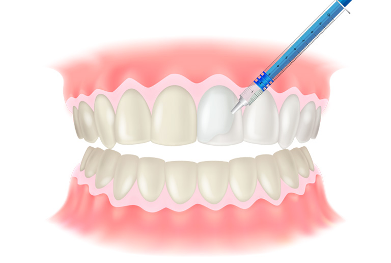 オフィスホワイトニング