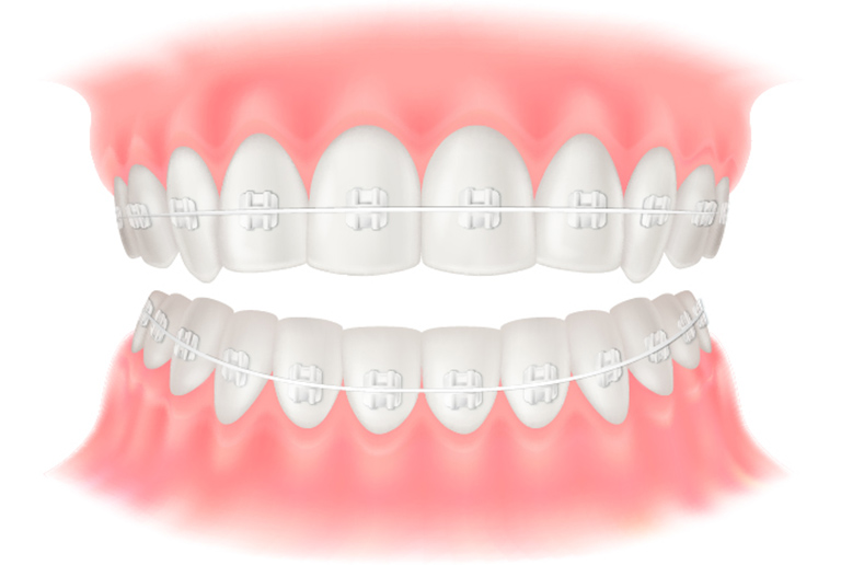 表側矯正（ワイヤー矯正）