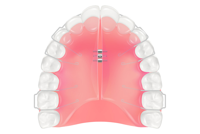 床矯正（しょうきょうせい）