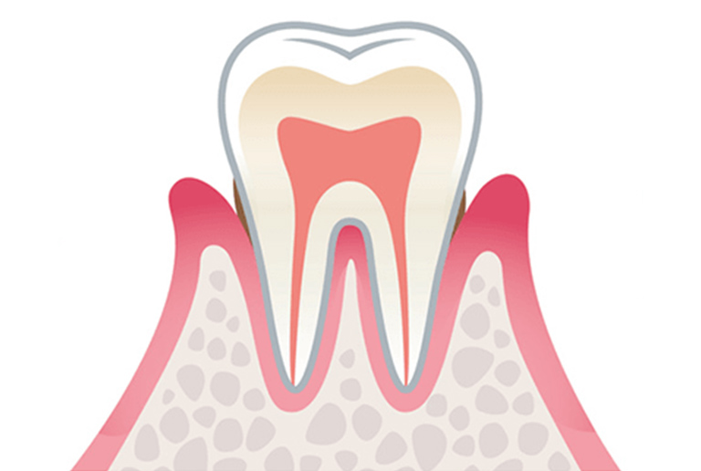 軽度歯周病