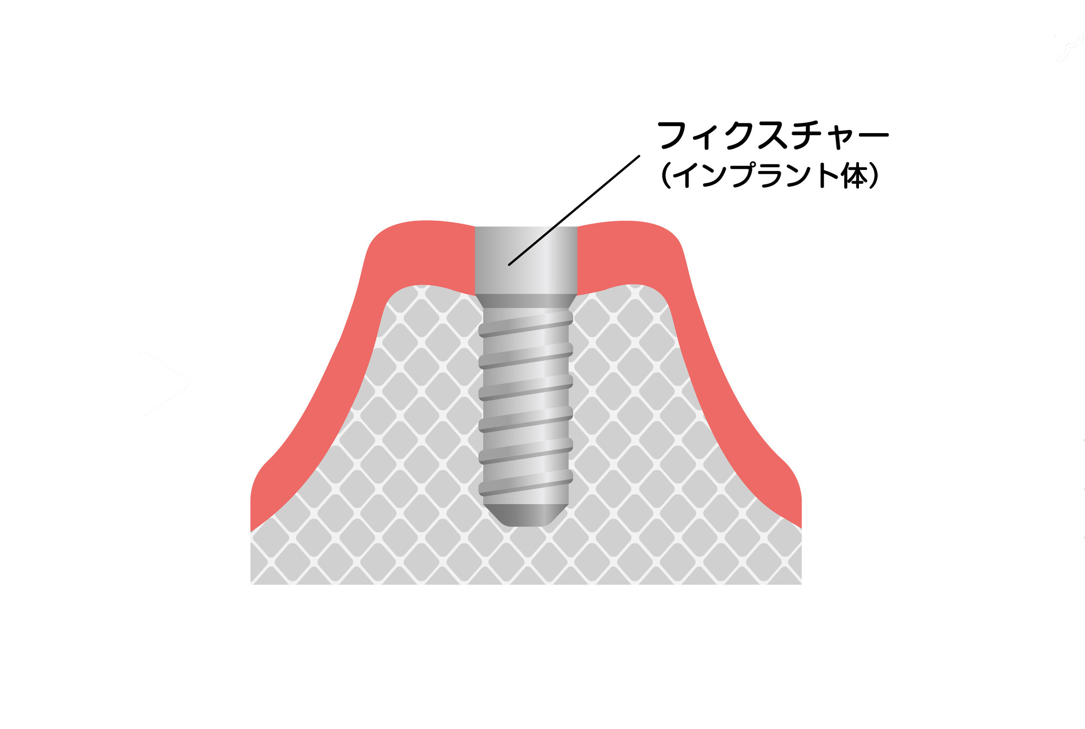 インプラント体（人工歯根）