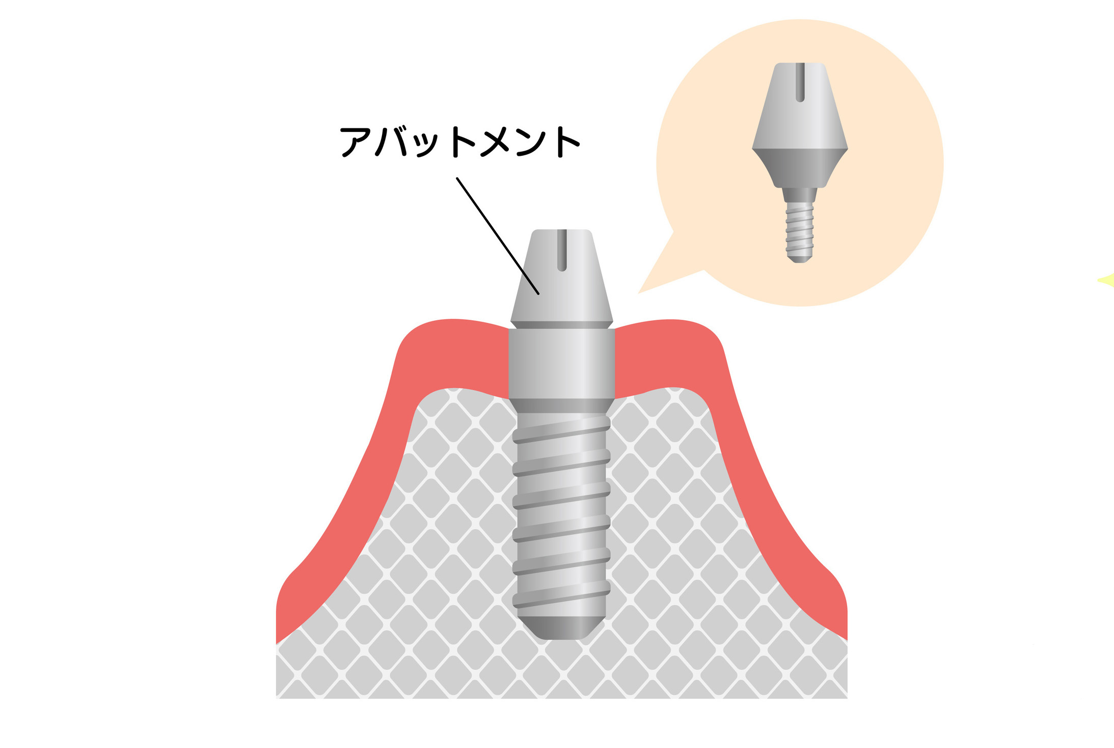 アバットメント
