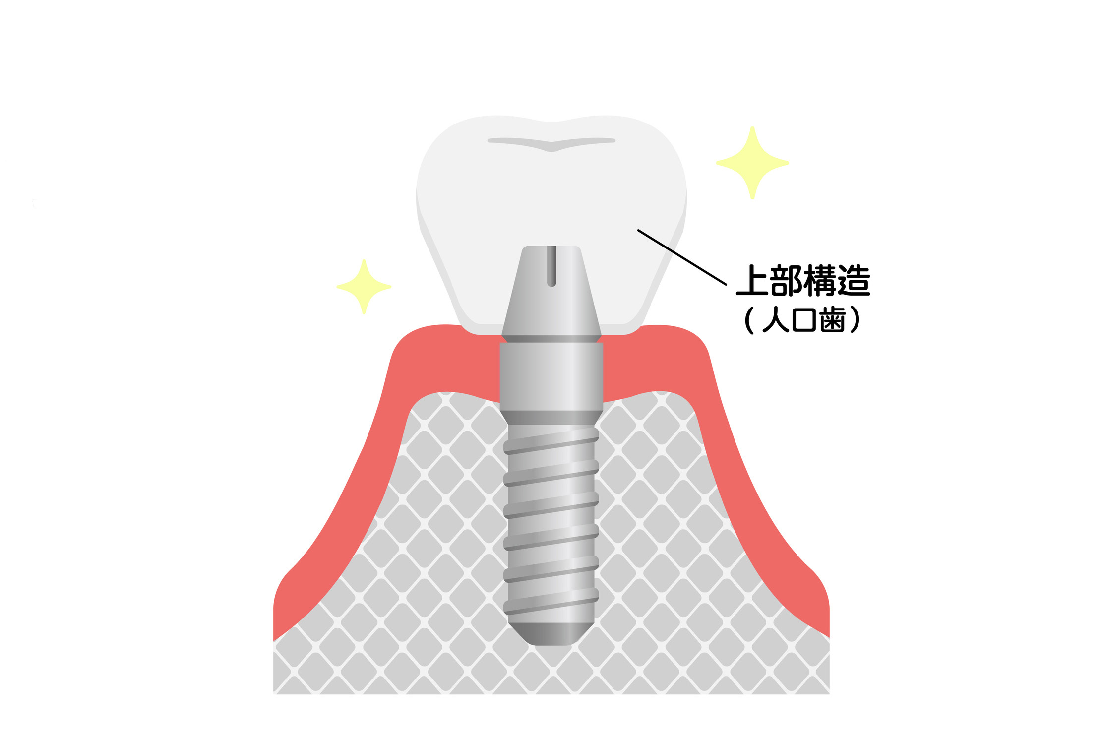 上部構造（人工歯）