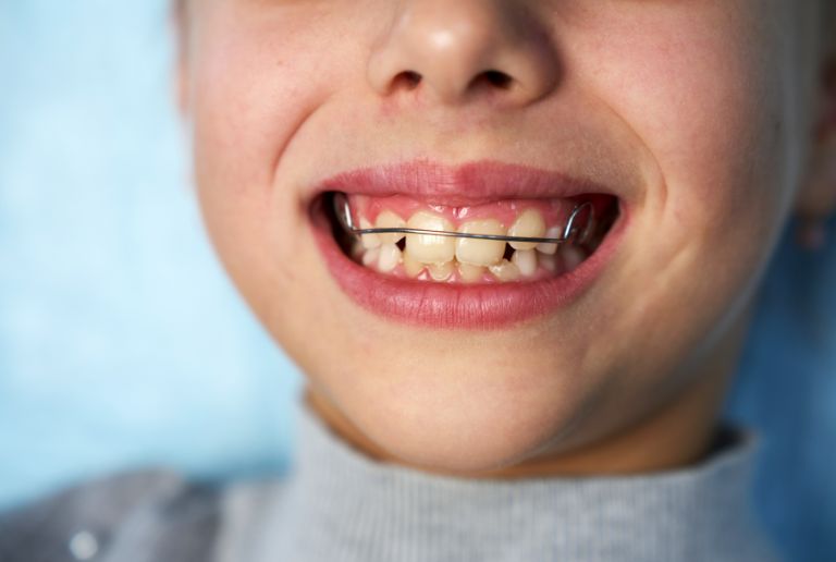 固定式ワイヤー装置